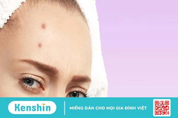 Nguyên nhân gây mụn bọc ở trán và cách điều trị 1