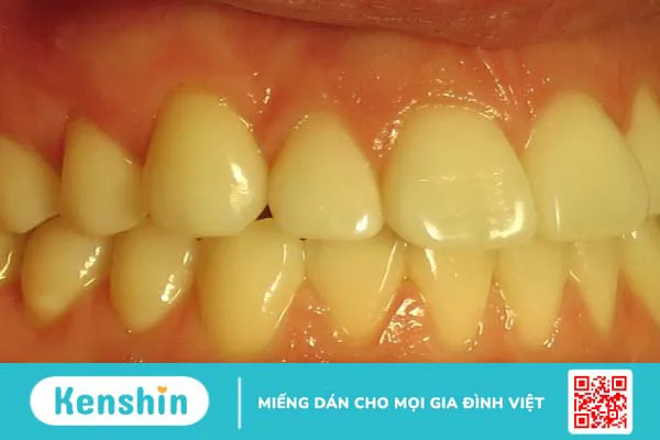 Nguyên nhân gây răng vàng bẩm sinh và cách khắc phục 1