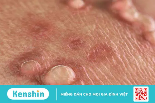 Nguyên nhân nhiễm HPV là gì? Biện pháp phòng tránh như thế nào? 3