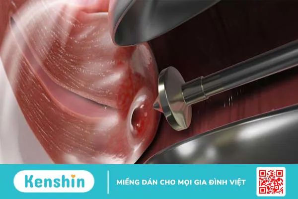 Nguyên nhân u nang nhầy ở môi và cách điều trị 3