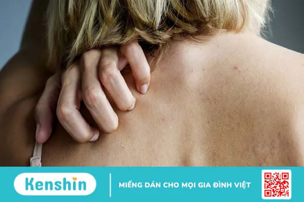 Nguyên nhân và cách điều trị khi bị ngứa toàn thân 1