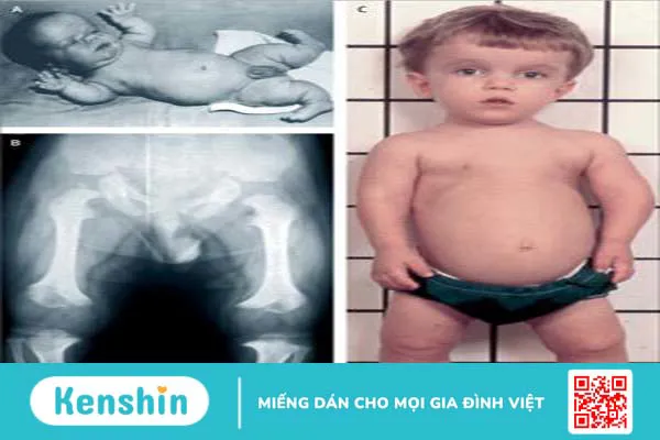 Loạn sản sụn xương: Nguyên nhân và cách quản lý 2