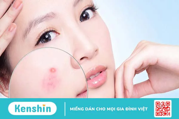 Nguyên nhân và cách điều trị sẹo rỗ đáy nhọn hiệu quả 2