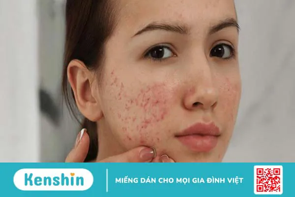 Nguyên nhân gây ra mụn viêm đỏ ở má và cách điều trị 1