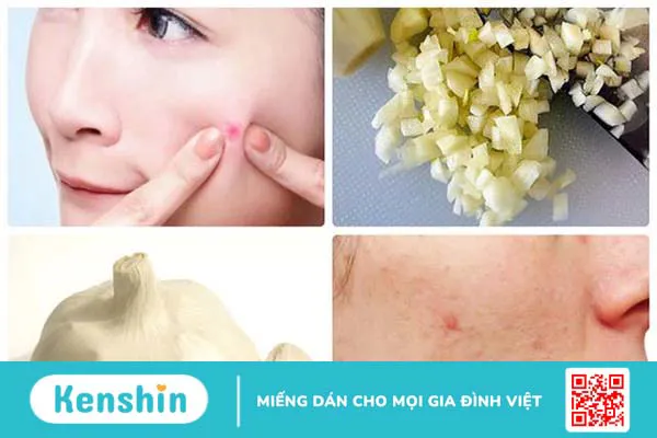 Nguyên nhân gây ra mụn viêm đỏ ở má và cách điều trị 3