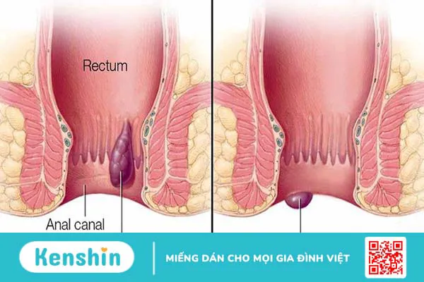 nguyen-nhan-va-cach-khac-phuc-tac-mach-tri-3