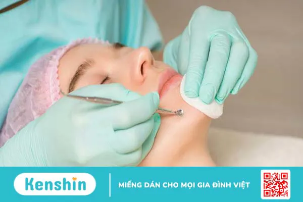 mụn đầu đen ở cằm 3