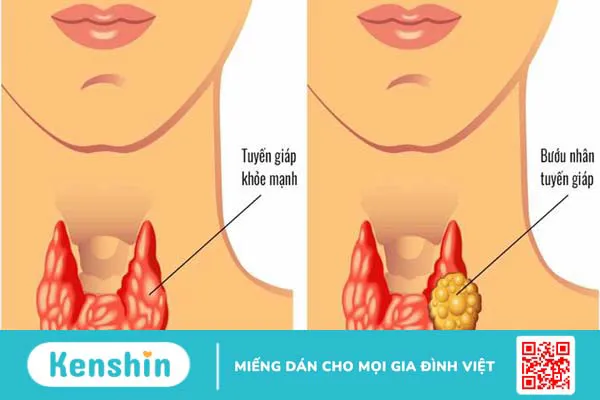 Nhân tuyến giáp có nguy hiểm không? 1