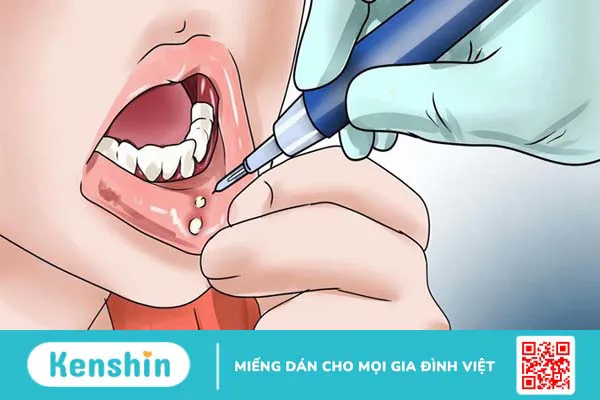 Nhiệt miệng là gì và những cách phòng tránh nhiệt miệng 1