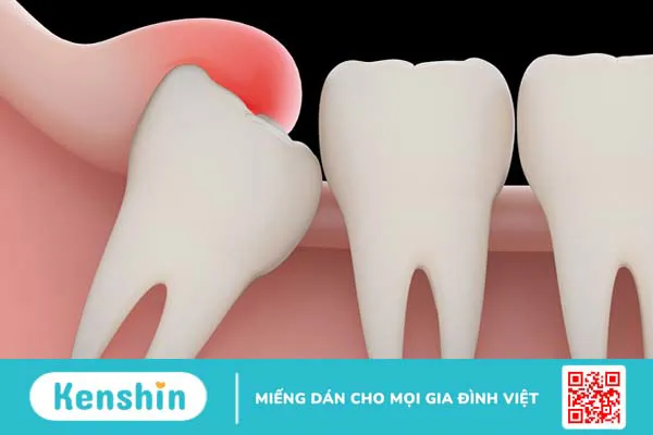 Nhổ răng hàm có nguy hiểm không? 2