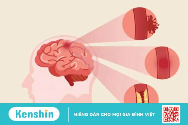 Nhồi máu não nhân bèo: Nguyên nhân, triệu chứng và phương pháp điều trị 1