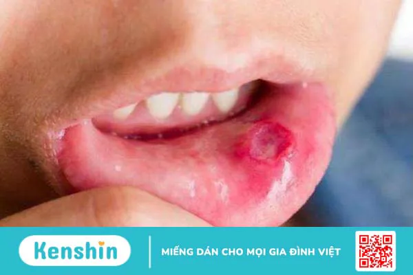 Những cách ăn uống đúng cách khi bị nhiệt miệng 1