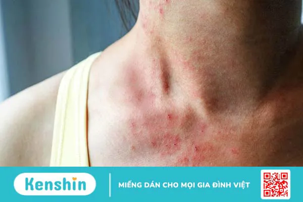 Những cách chăm sóc da cổ khỏi tình trạng mụn 1