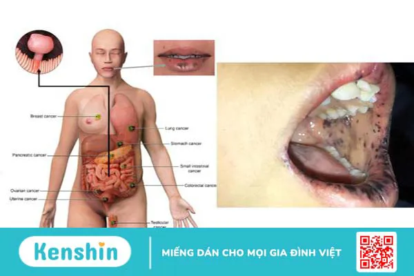 Giải đáp 5 câu hỏi thường gặp về hội chứng Peutz-Jegher 1