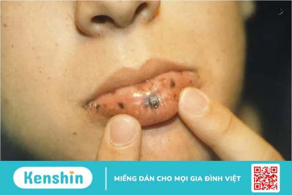 Giải đáp 5 câu hỏi thường gặp về hội chứng Peutz-Jegher 3