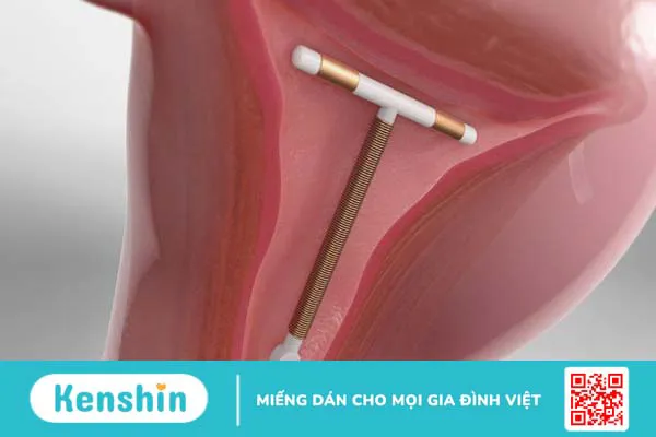 Những dấu hiệu lệch vòng tránh thai chị em phụ nữ nên biết2