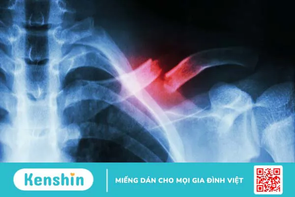 Những điều cần biết khi chăm sóc người bị gãy xương đòn 1