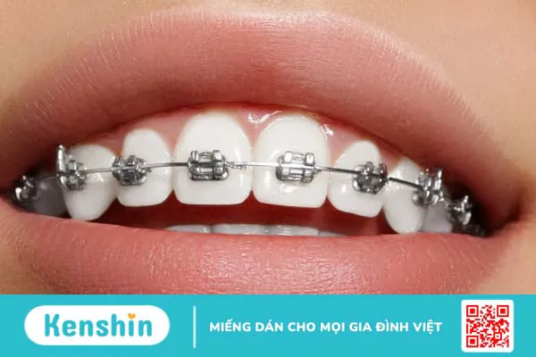 Những điều cần biết khi niềng răng mắc cài tự buộc 2