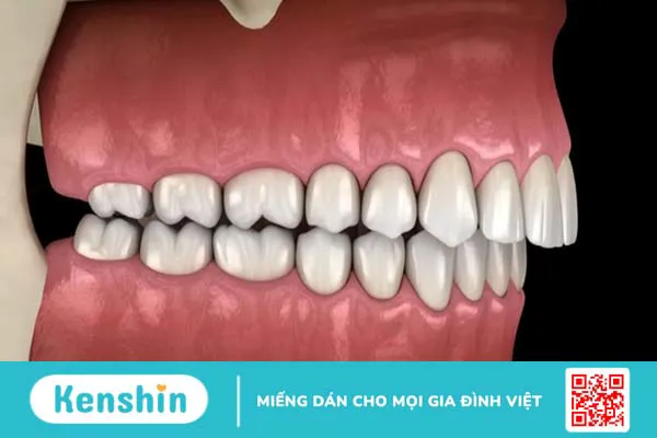 Những điều cần biết khi niềng răng mắc cài tự buộc 3