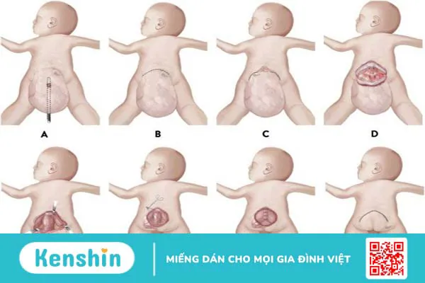 Những khối u vùng xương cụt thường gặp và phương pháp điều trị 2