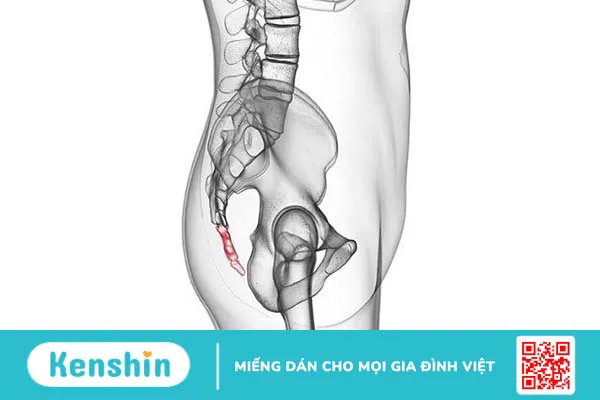 Những khối u vùng xương cụt thường gặp và phương pháp điều trị 3