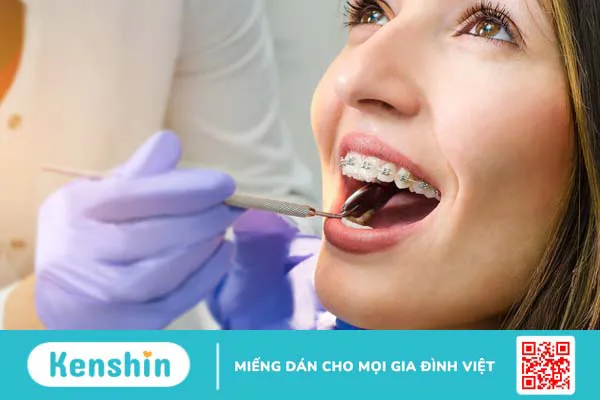 5 sự thật về phương pháp mài kẽ răng - Đọc ngay! 5