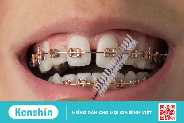 5 sự thật về phương pháp mài kẽ răng - Đọc ngay! 6