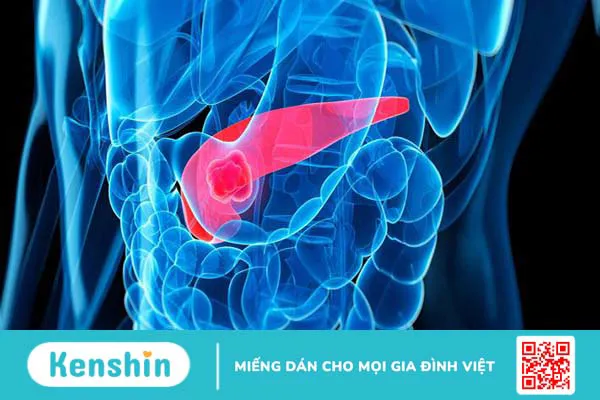 Những triệu chứng ung thư tuyến tụy giai đoạn đầu 1