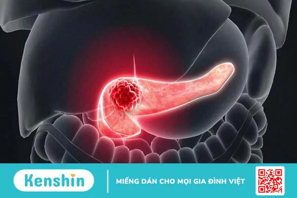 Những triệu chứng ung thư tuyến tụy giai đoạn đầu 2