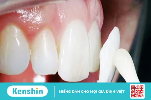 Nhược điểm của dán răng sứ là gì? Lưu ý sau khi dán răng sứ 1