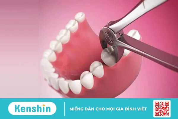 Niềng răng trong suốt có cần nhổ răng không? Lợi ích của Invisalign 3