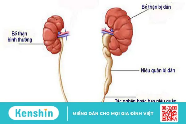 Niệu quản giãn do đâu? Chẩn đoán và điều trị thế nào? 1