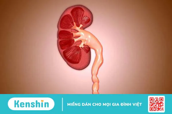 Niệu quản giãn do đâu? Chẩn đoán và điều trị thế nào? 2