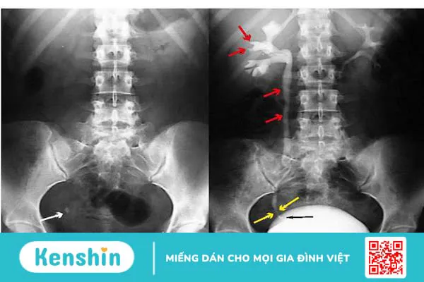 Niệu quản giãn do đâu? Chẩn đoán và điều trị thế nào? 3