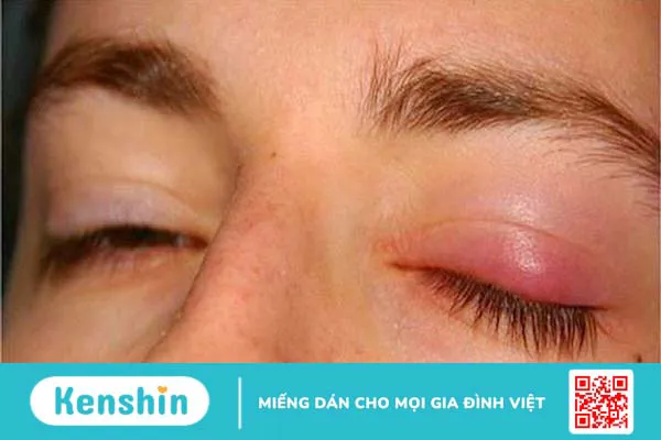 Nổi hạch ở mí mắt trên: Nguyên nhân, triệu chứng và cách điều trị 1