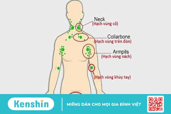 Nổi hạch ở vai là bệnh gì? Có nguy hiểm không? 1