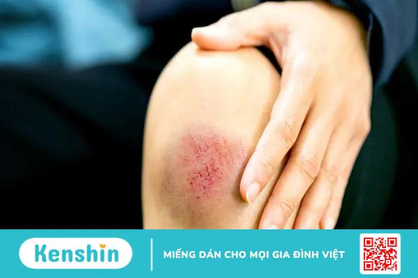 Nổi hạch ở vai là bệnh gì? Có nguy hiểm không? 2