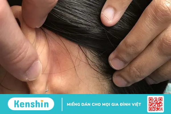 Nổi hạch sau tai có nguy hiểm không?