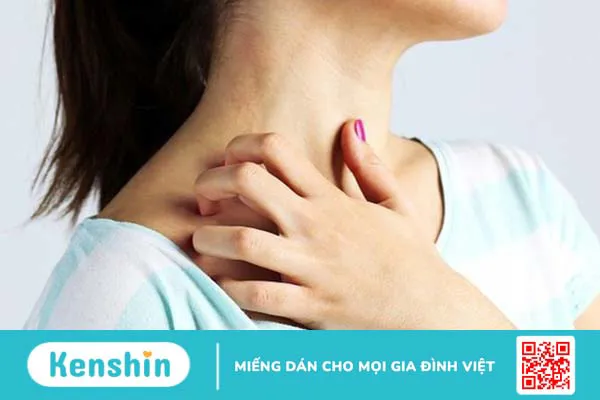 Nổi mề đay sau sinh: Những điều bạn cần biết 1