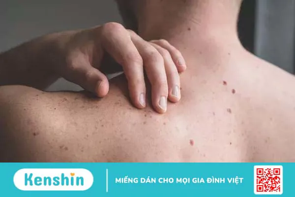 Nốt ruồi bị ngứa là dấu hiệu gì về sức khỏe? 2