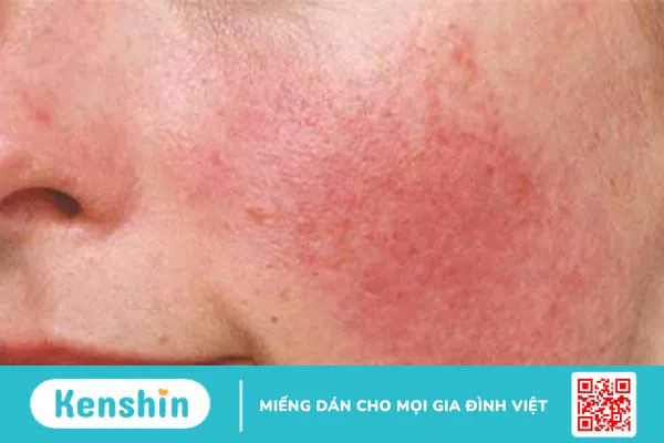 Nếu không peel đúng cách, da dễ bị tổn thương và ửng đỏ