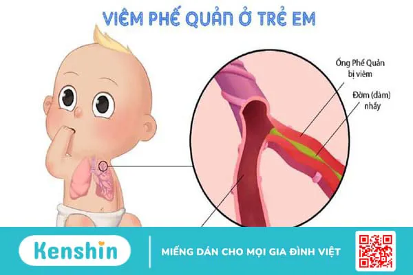 Phác đồ điều trị viêm phế quản ở trẻ em và cách chăm sóc trẻ bệnh 1