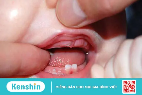 Phân biệt hiện tượng trẻ sốt mọc răng và sốt thông thường 1