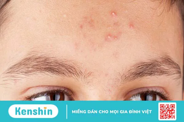 Phân biệt những loại mụn trên da 1