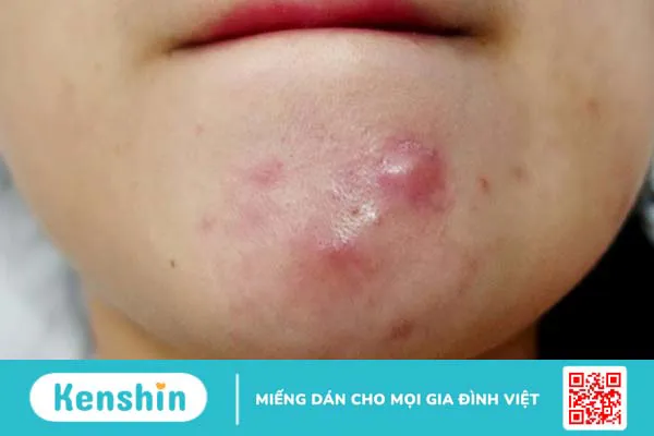 Phân biệt những loại mụn trên da 3