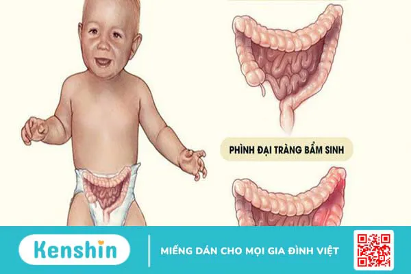 Phân su trẻ sơ sinh là gì? Có những bệnh lý phân su nào? 4