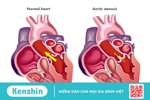 Phẫu thuật sửa van tim hai lá và phẫu thuật thay van tim hai lá ít xâm lấn 1