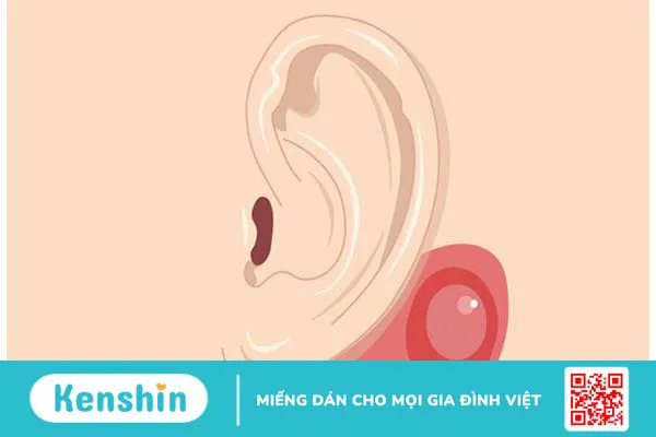 Phẫu thuật tiệt căn xương chũm là gì? Quy trình thực hiện như thế nào? 1