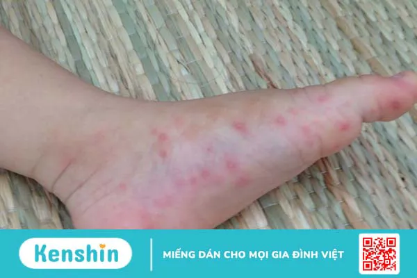 Phù nề xuất huyết cấp tính - căn bệnh lần đầu xuất hiện tại Việt Nam 2