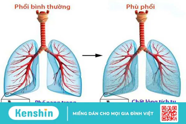 Phù phổi cấp: Cơ chế, chẩn đoán và điều trị 1